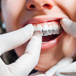 dentist placing clear aligner on patients teeth