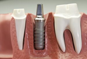 Model of titanium implant post