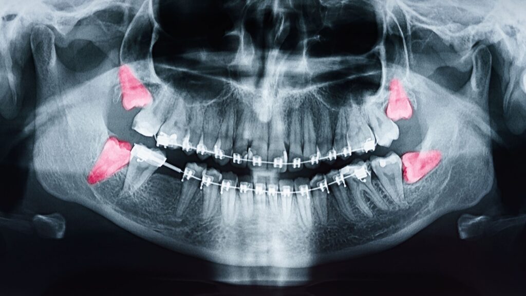 X-ray showing 4 wisdom teeth highlighted red